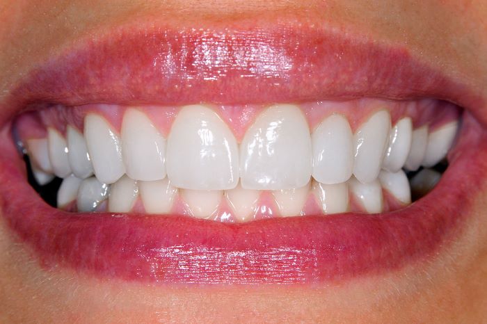 Aligned Teeth