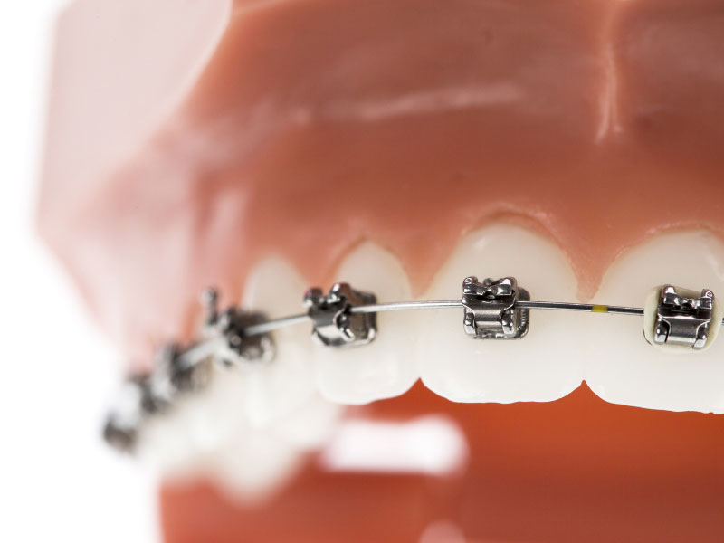 Orthodontic Improvements